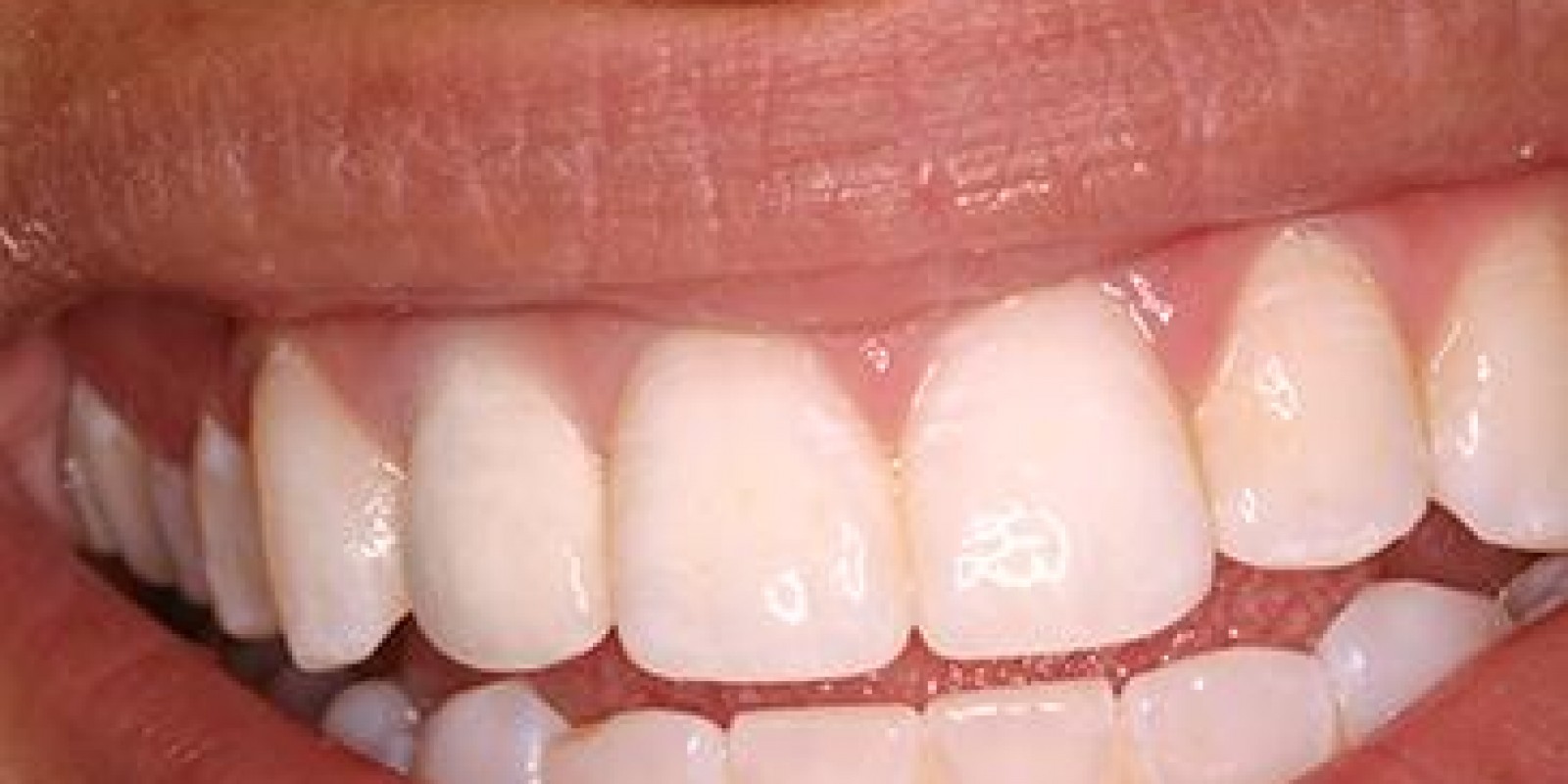 Depois do Implante Dentário