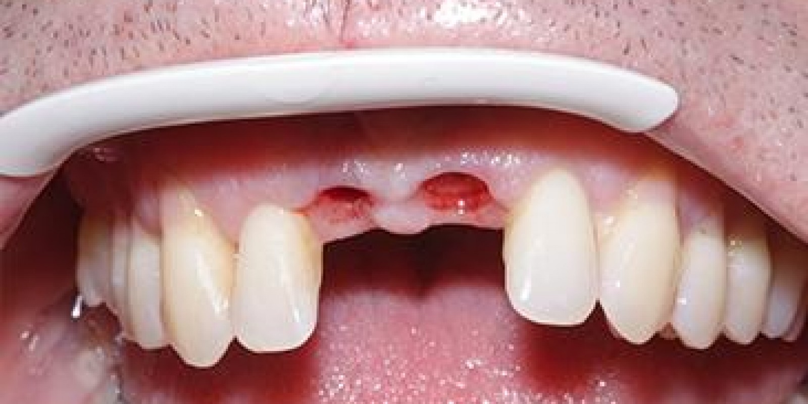 Antes do Implante Dentário