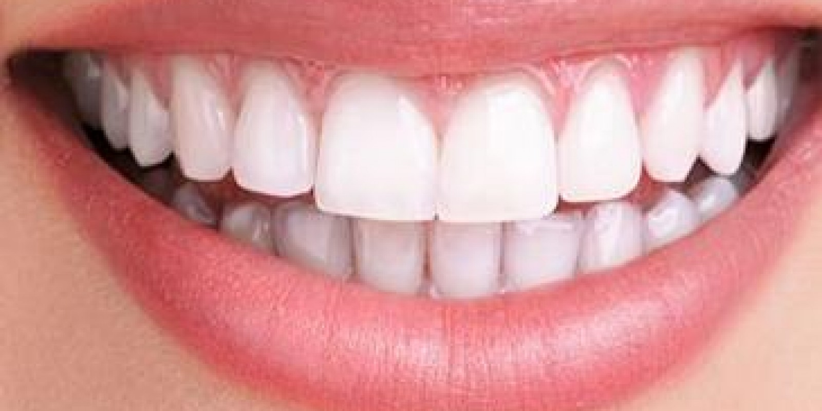 Depois do Clareamento do dente