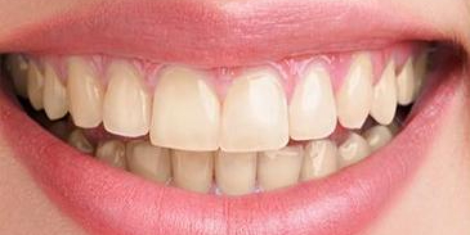 Antes do Clareamento do dente