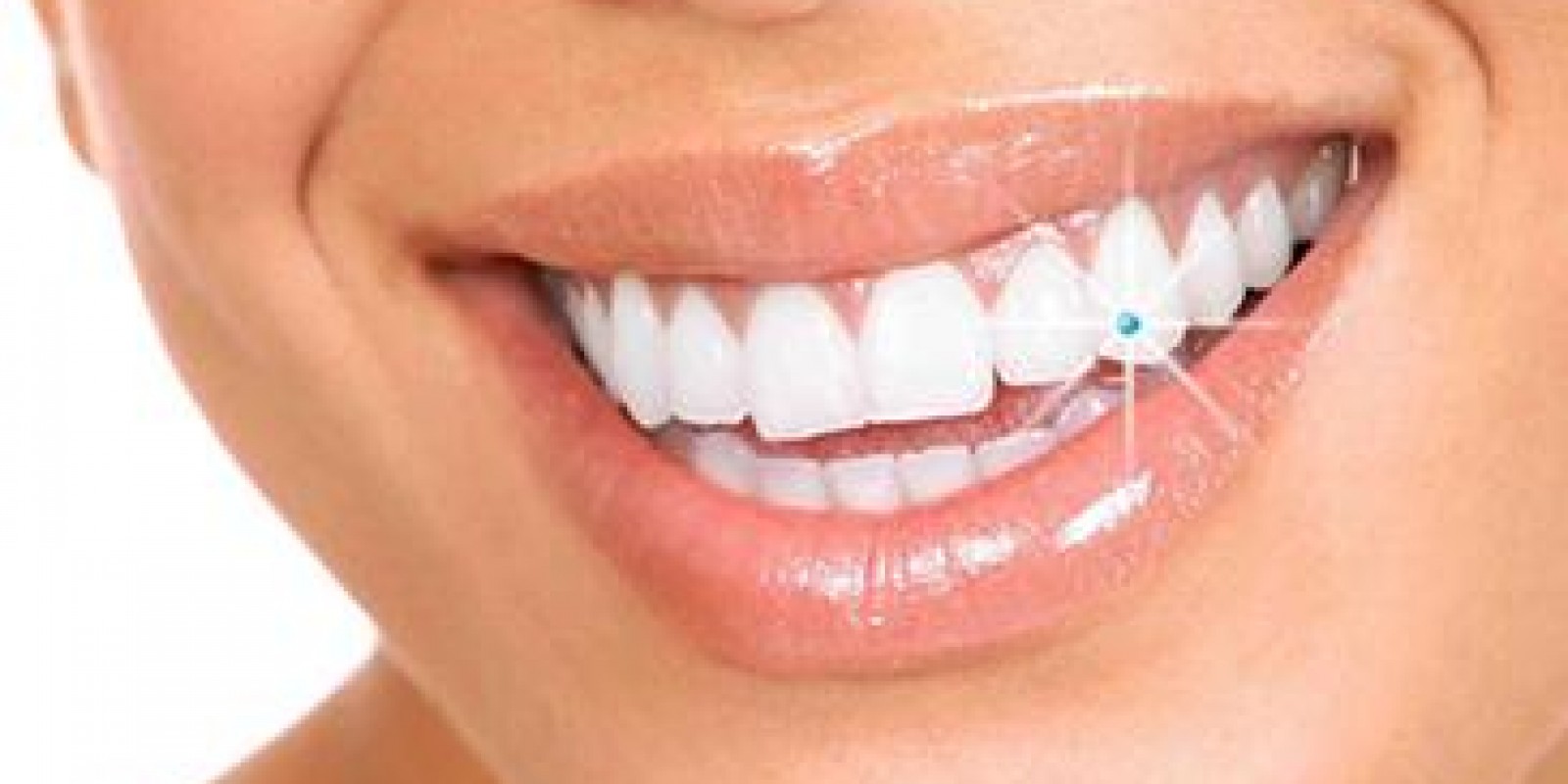 Depois do Jóias no dente